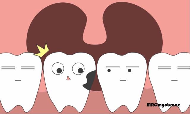 牙活动有疼痛感用甲硝唑可以吗,牙根一吸就疼吃甲硝唑好使吗