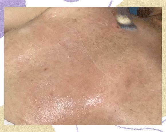 医美做什么能永远不长痘,脸很多痘坑做什么医美