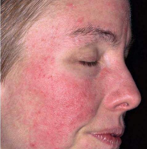 敏感肌脸上干燥起皮怎么办,脸上敏感皮肤干起皮怎么快速变好