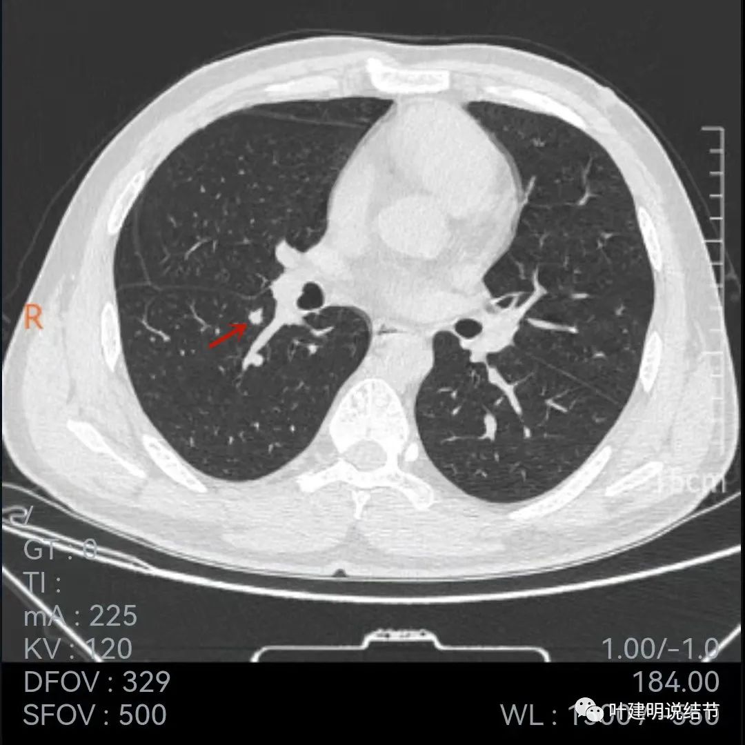 问诊分析：存在了4年的实性结节会不会是肺癌？
