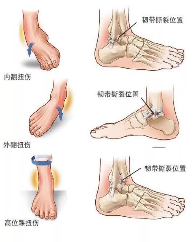 跑步后腿疼治疗办法有哪些,跑步腿疼脚疼怎么回事