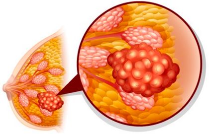 长期便秘对肠道有危害,女性长期便秘有什么危害