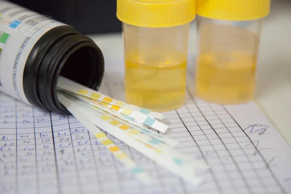 尿蛋白4+怎么治疗,尿蛋白4+吃什么药比较好