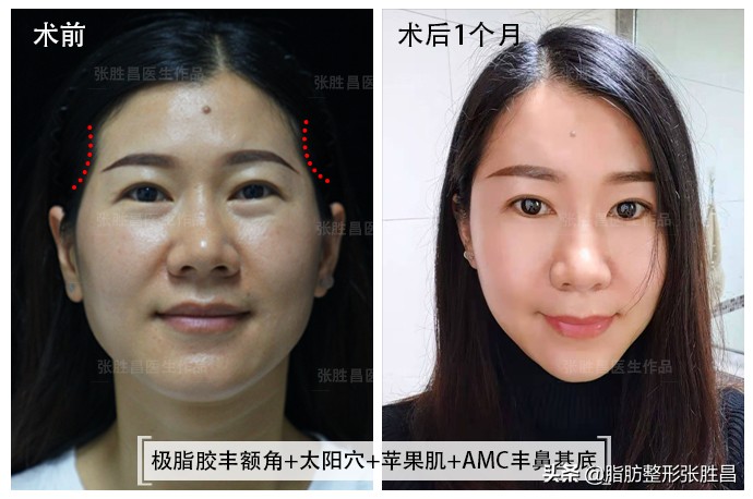 自体脂肪除皱是怎么样的,自体脂肪除皱的优点缺点有哪些