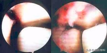 陈旧性踝关节损伤的治疗,踝关节损伤现场处理视频