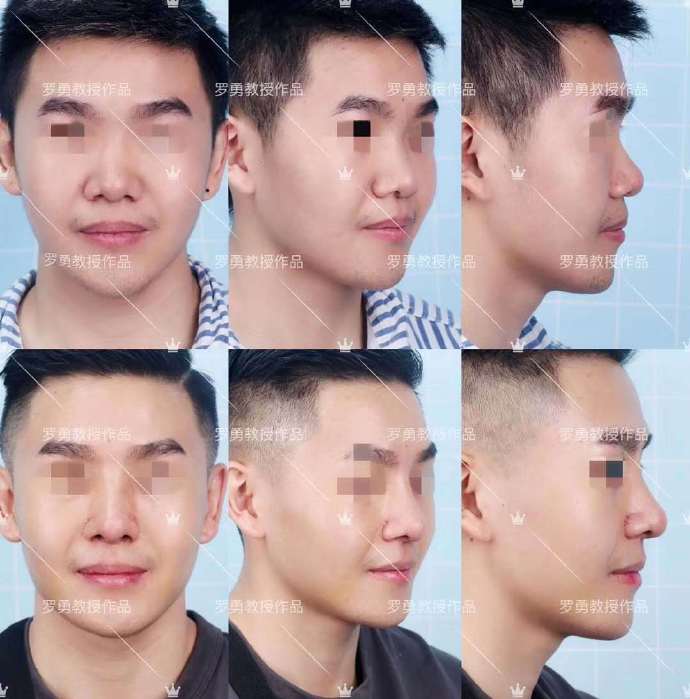 鼻整形之后怎么调理,鼻子整形修复注意事项