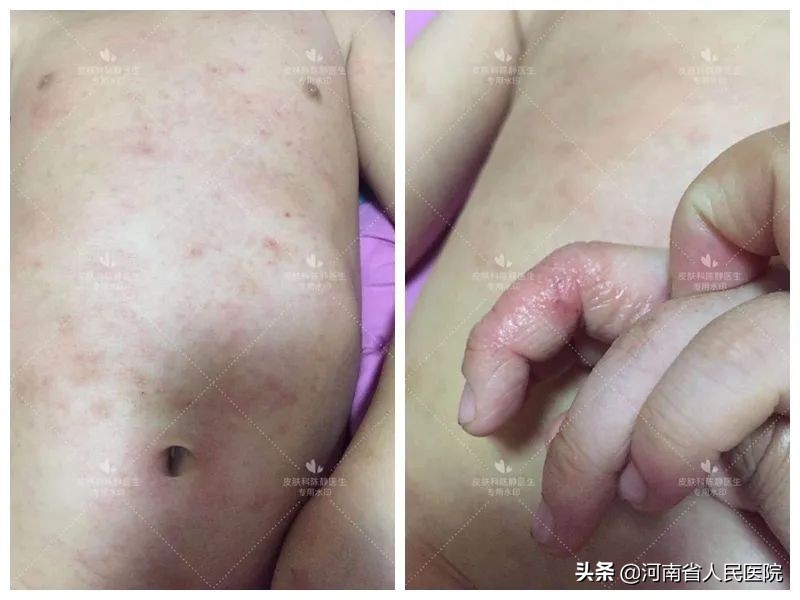 被痒吞噬的人们，是时候揭开这“湿疹”的真面目了