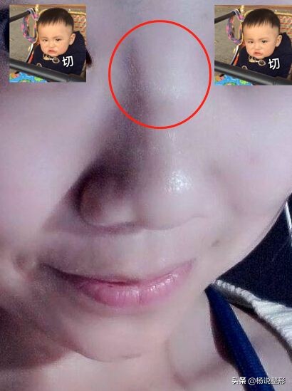 捏鼻梁神器变高真的吗,徒手捏鼻梁是真的吗