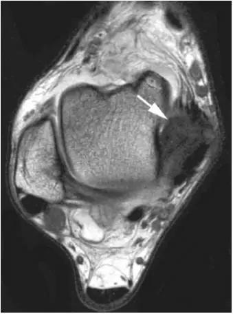 踝关节撞击症问诊,踝关节内侧撞击综合症位置图