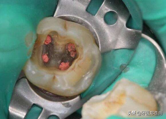 做了根管治疗的牙能矫正吗,根管治疗的牙还能用三十年吗