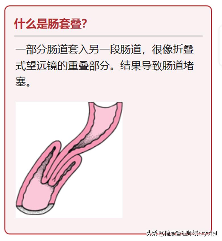 宝宝突然哭闹腹痛警惕急性肠套叠,儿童肠胃炎和肠套叠怎么区分