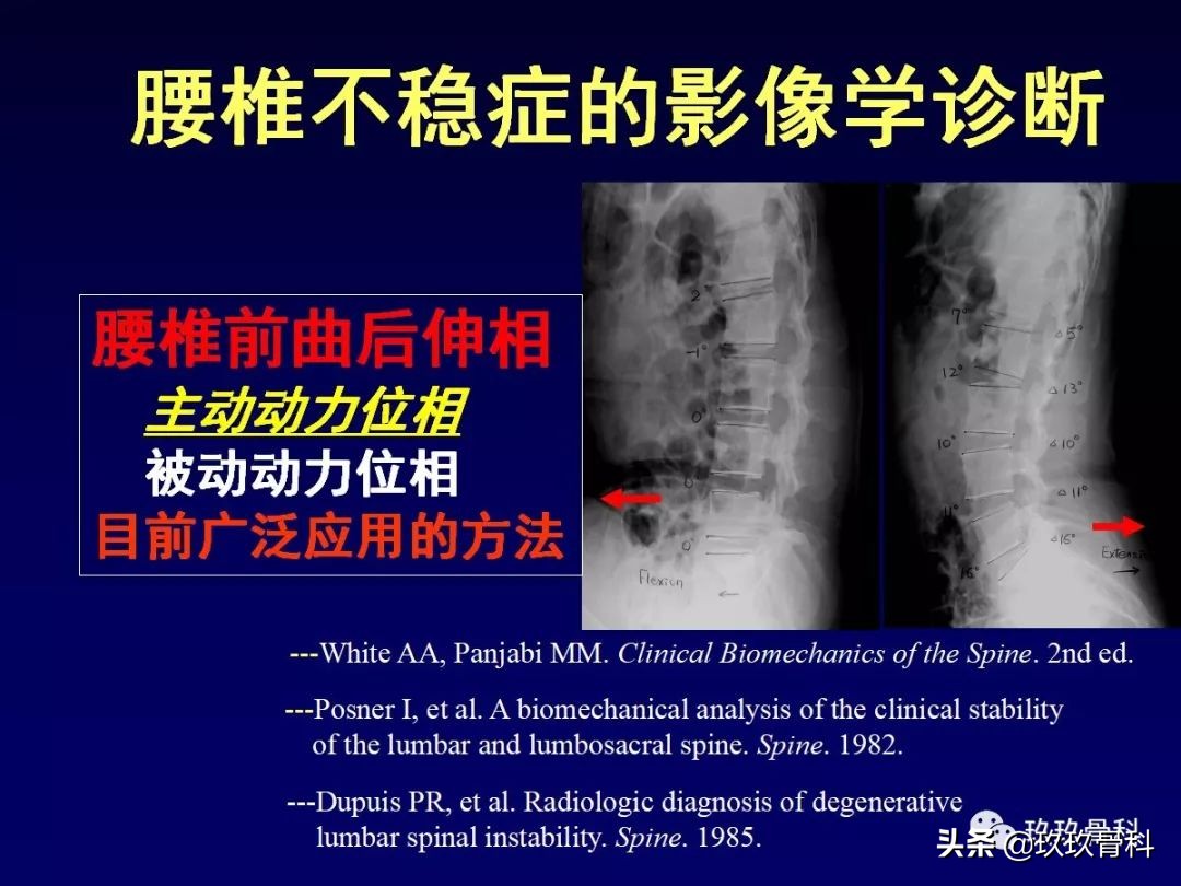腰椎不稳最坏的结果,腰椎不稳的最佳治疗方法