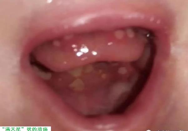 9岁孩子口腔溃疡怎么办,孩子反复口腔溃疡求良方