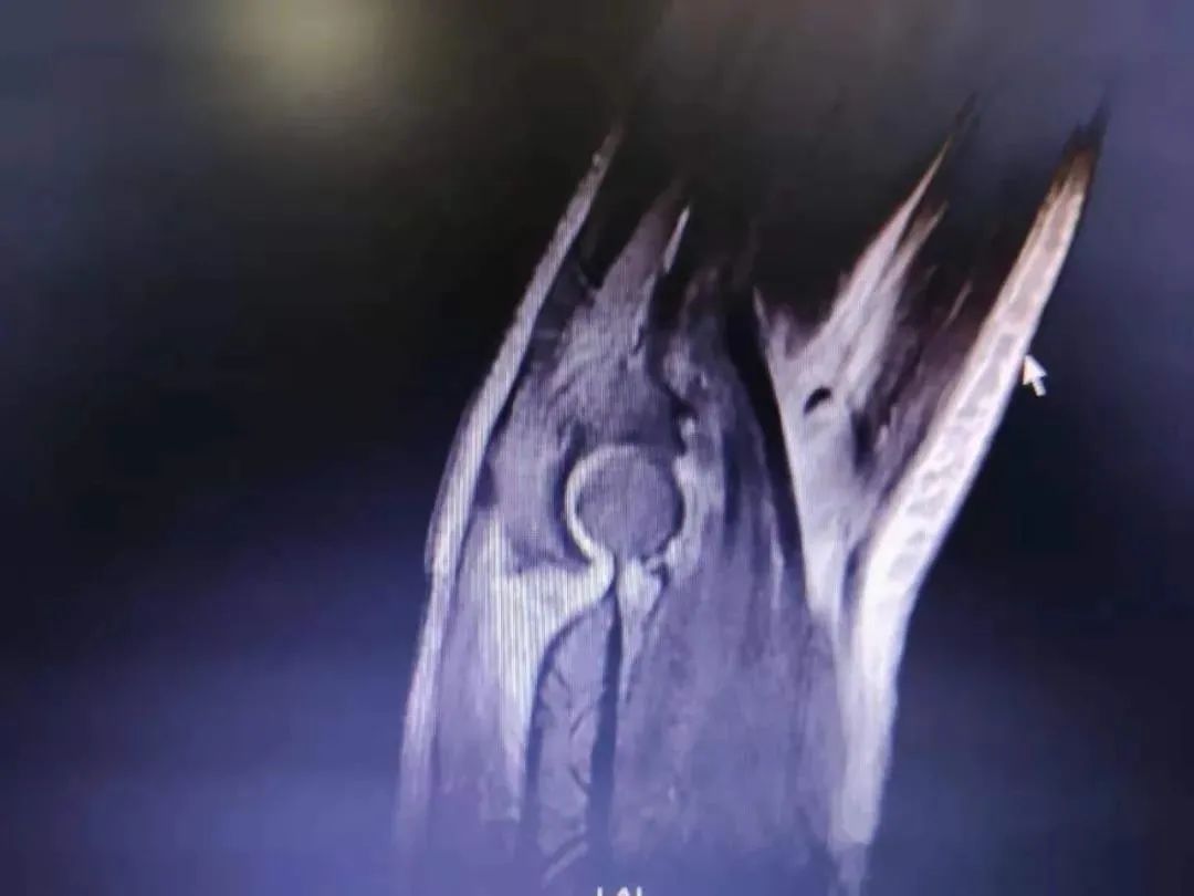 创伤导致肘关节僵硬怎样才能康复,肘关节僵硬康复训练正确方法