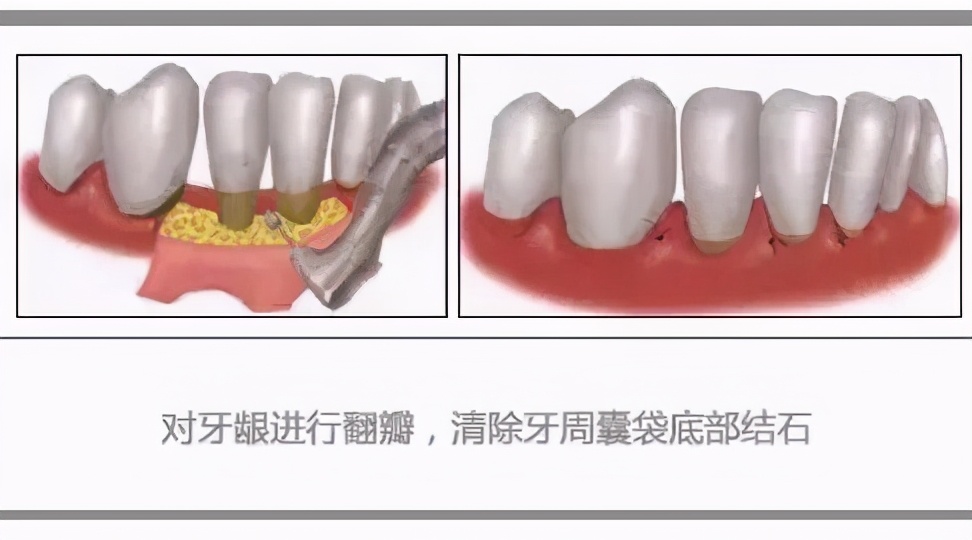 孕妇患上牙周病是什么原因,得了牙周病去哪里治疗