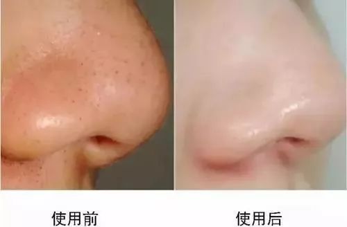 黑头粉刺毛孔粗大螨虫怎么去除,去黑头粉刺螨虫痘痘深层毛孔清洁