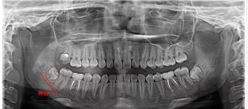 拔智齿痛到怀疑人生,拔了智齿痛的怀疑人生