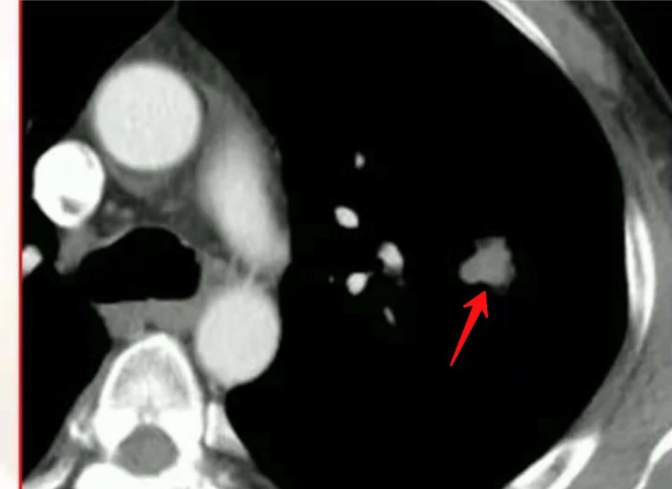 与肺癌病人一起生活需要注意什么,与肺癌抗战的第七个月