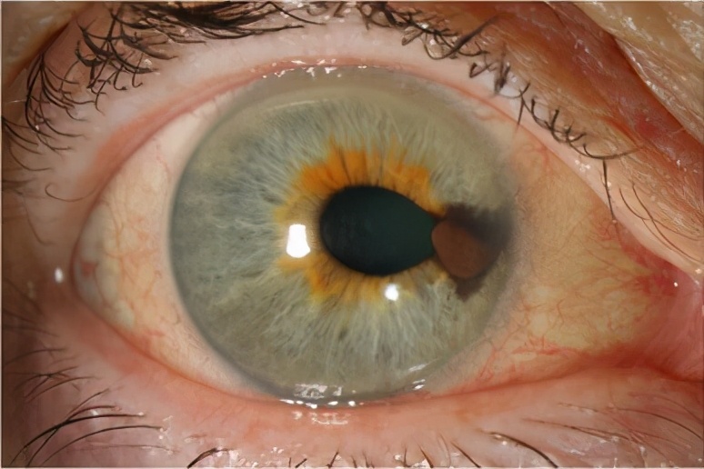 新型TCR疗法tebentafusp治疗葡萄膜黑色素瘤