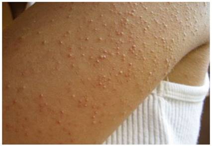 如何摆脱鸡皮肤的恐惧,简单两步轻松搞定鸡皮肤