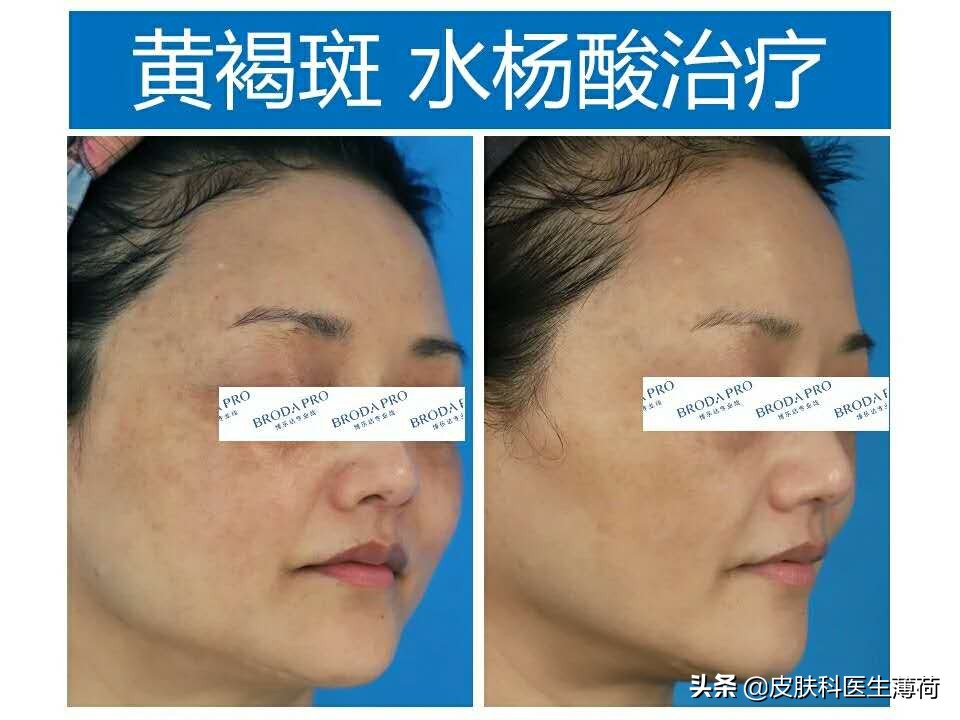 水杨酸精华果酸去闭口粉刺,刷酸去黑头收缩毛孔用哪个产品好