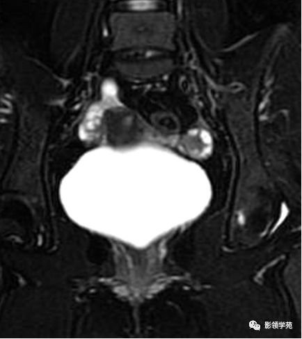 宫颈癌mri诊断,宫颈癌的mr扫描技术
