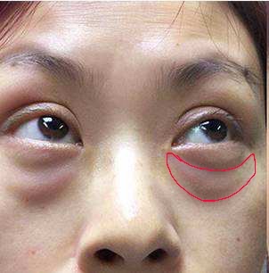 眼袋越来越严重赶紧试试这个方法,大家是否知道眼袋形成的原因呢