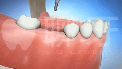 牙齿需要种植牙会经历几个步骤,种植牙流程什么情况需要做骨粉