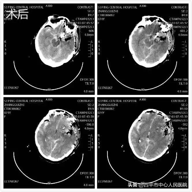 精准排雷再现新高—神经外科在6月份成功救治6例颅内动脉瘤患者