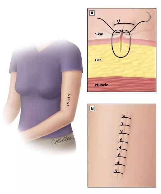 各种皮肤缝合伤口的方法对比