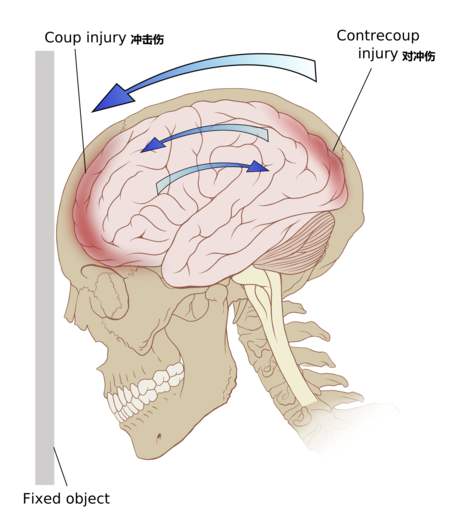 怎样会引起颅压高,颅压增高是怎么引起的
