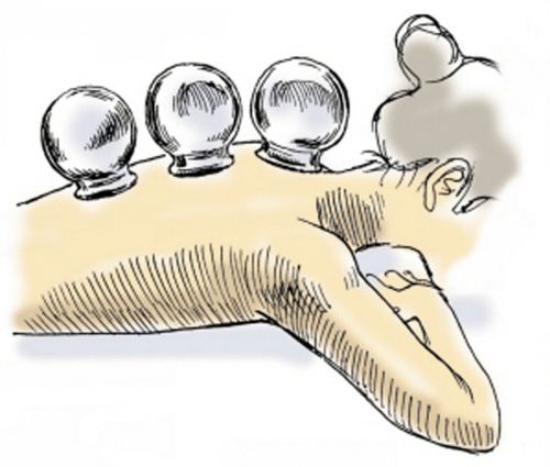 后背疼痛是不是要去拔火罐,后背疼拔罐有缓解吗