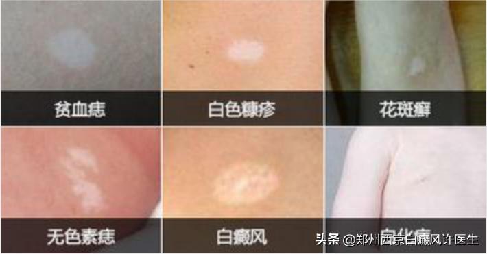 治疗白癜风时务必重视这几大事项,治疗白癜风怎样防止被骗