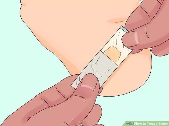 怎么预防跑步起水泡,一到夏天跑步脚就起泡怎么办