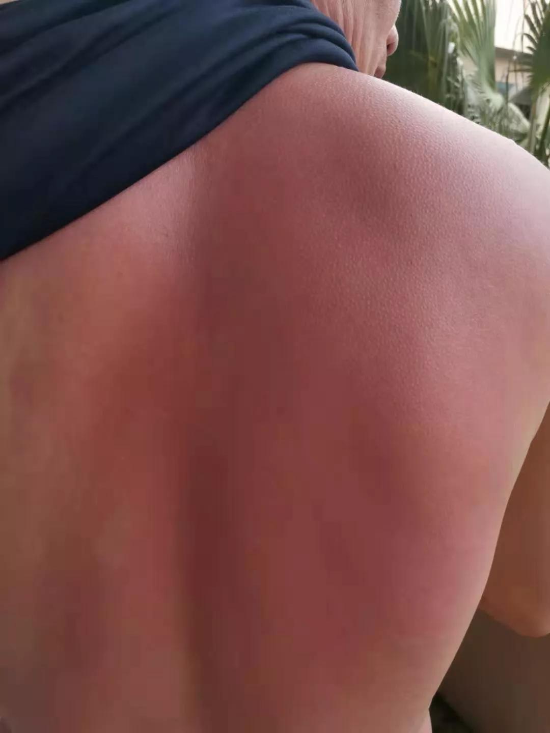 洪水之后需要注意的地方,洪水容易造成什么皮肤病