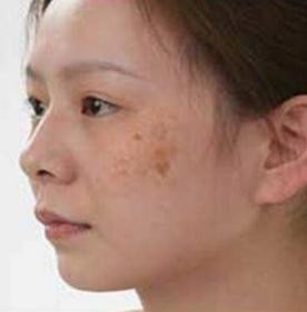 脸上有斑用什么护肤品祛斑效果好,40岁女人脸上长斑怎样有效祛斑