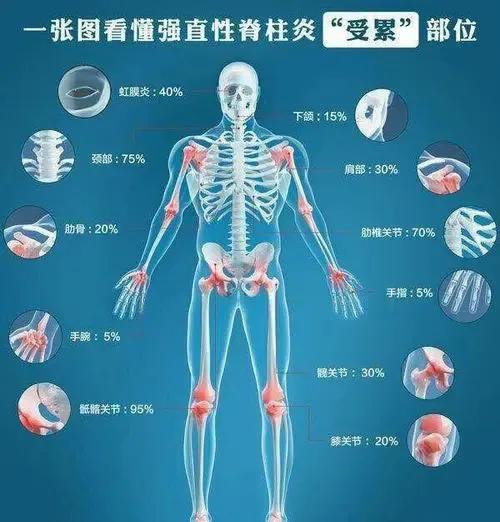 强直性脊柱炎治愈需要多少钱,强直性脊柱炎治疗费用可报销吗