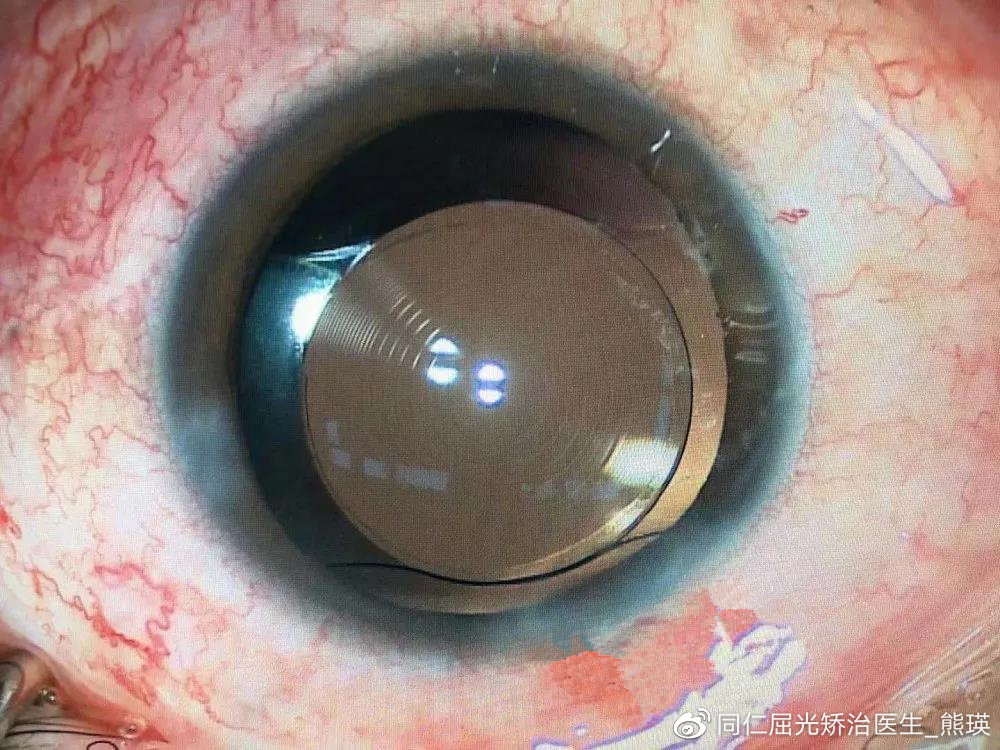 眼科护理手册最新版,眼底病科普手册