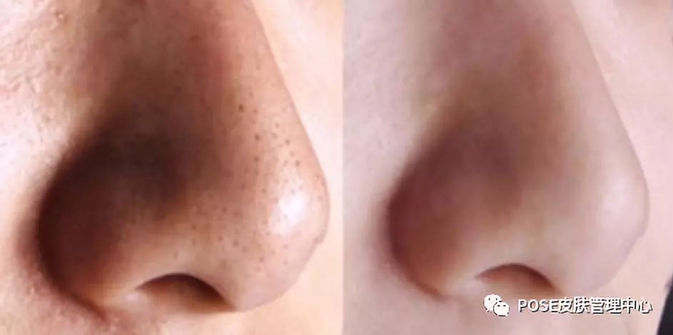 小气泡清洁推荐去黑头收缩毛孔,小气泡去黑头会让毛孔越来越大吗