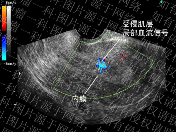 子宫内膜癌推荐广州医院,广州中山肿瘤医院子宫内膜癌