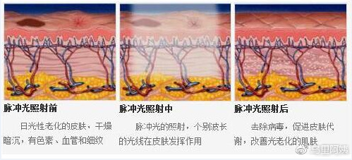 科普|光子嫩肤全攻略，做了光子后禁忌事项有哪些？