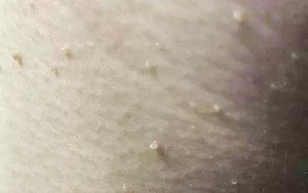 身上长了很多小疣是hpv感染了吗,身上有肿块是否是hpv造成