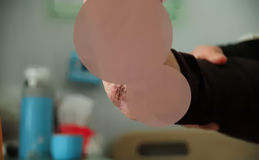 黑痣肿瘤,黑痣恶变的人