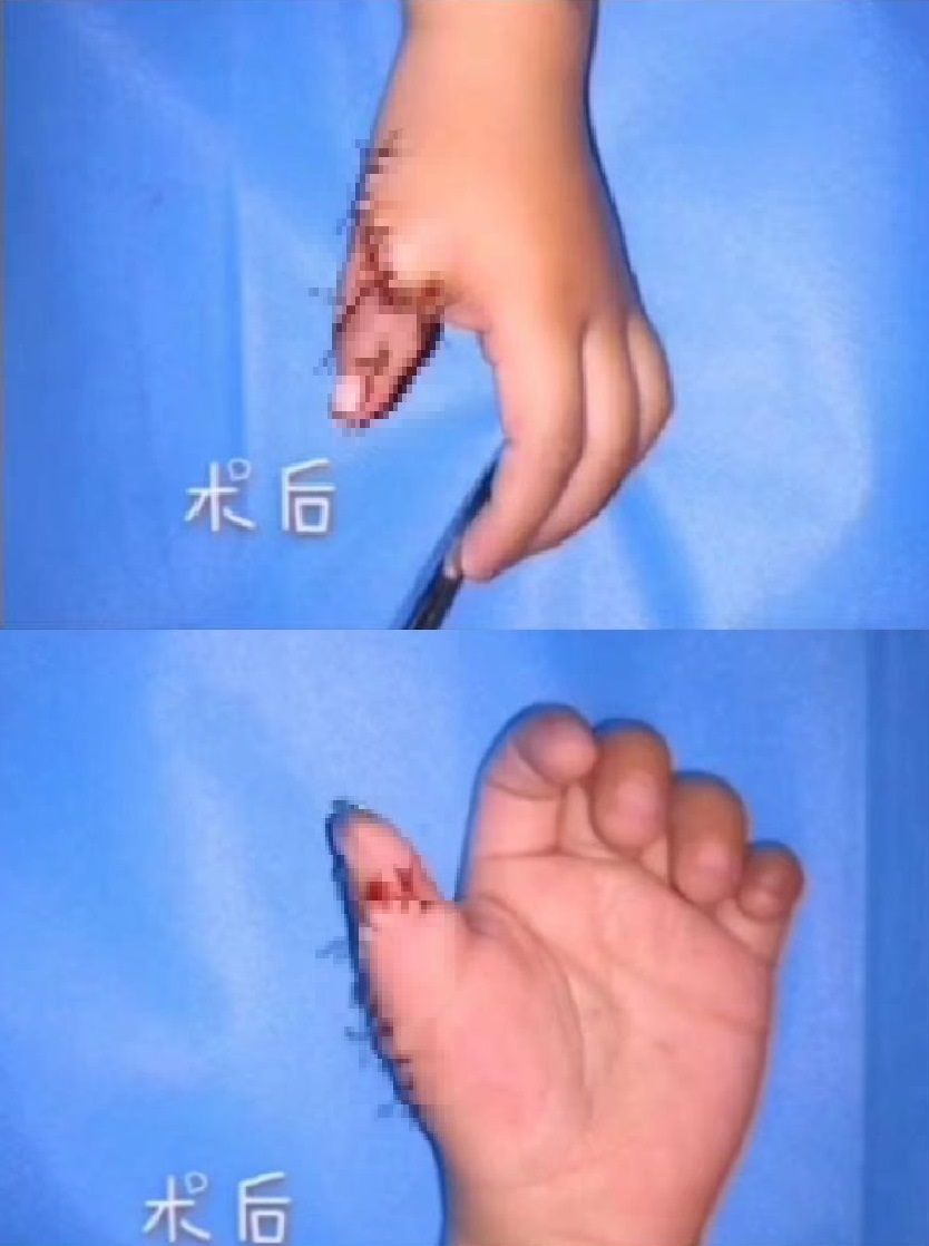 灏忓澶氭寚鐣稿舰鎬庝箞娌荤枟,鍎跨澶氭寚鐣稿舰鏈夊繀瑕佸垏闄ゅ悧