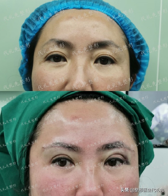 50岁做提眉眼袋手术能保持多久,提眉去眼袋手术15天图片
