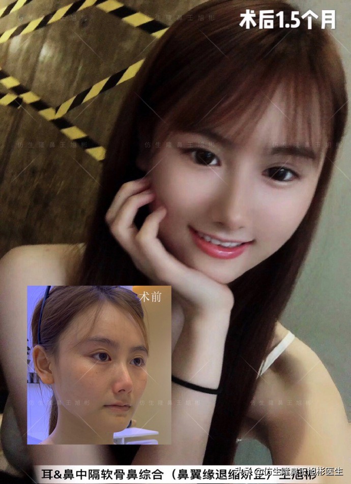 王旭彬:朝天鼻、露鼻孔,模特菲菲短鼻矫正手术后1.5个月