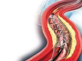 脑血管病好治吗,脑血管中医特色治疗