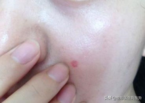 医生不会说的祛斑,医生不建议做光子美容