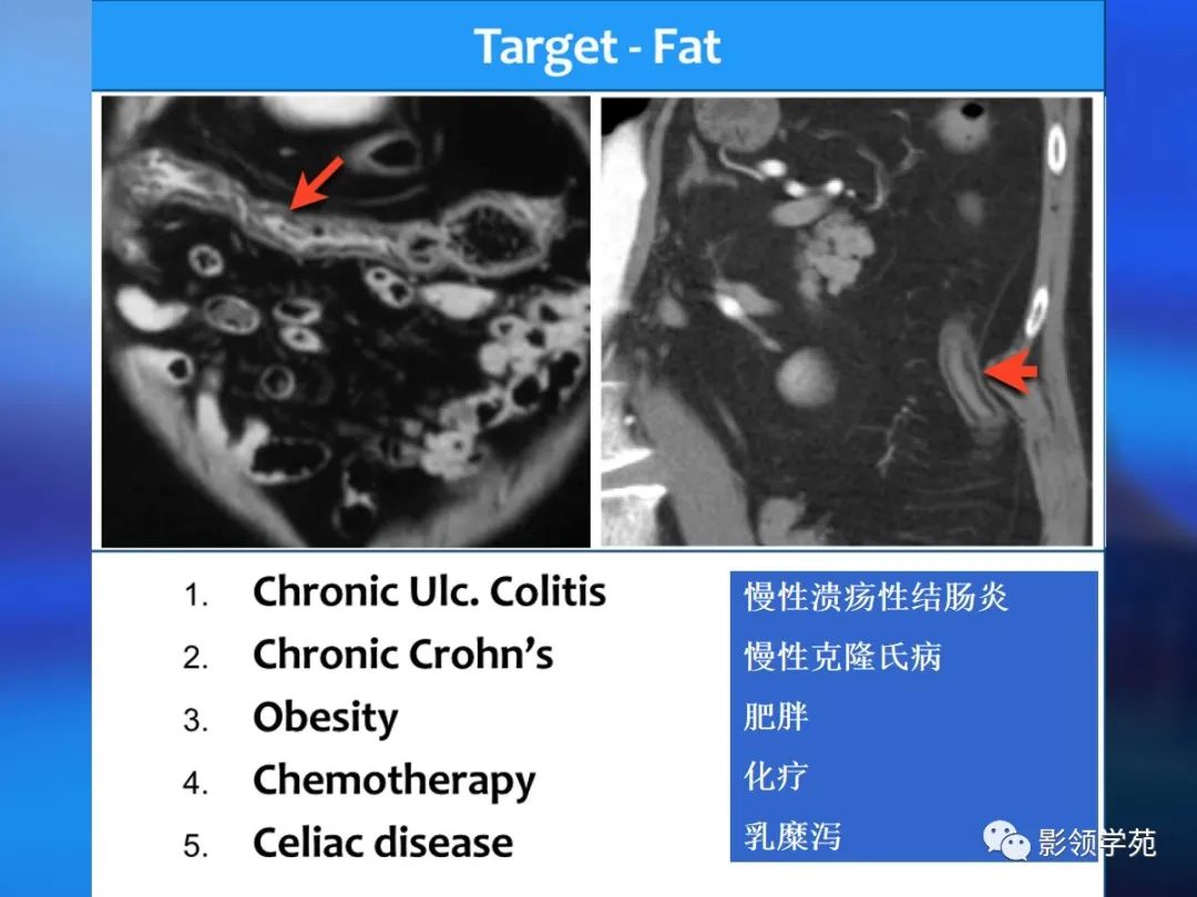 肠道内壁增厚,肠道扩张ct表现