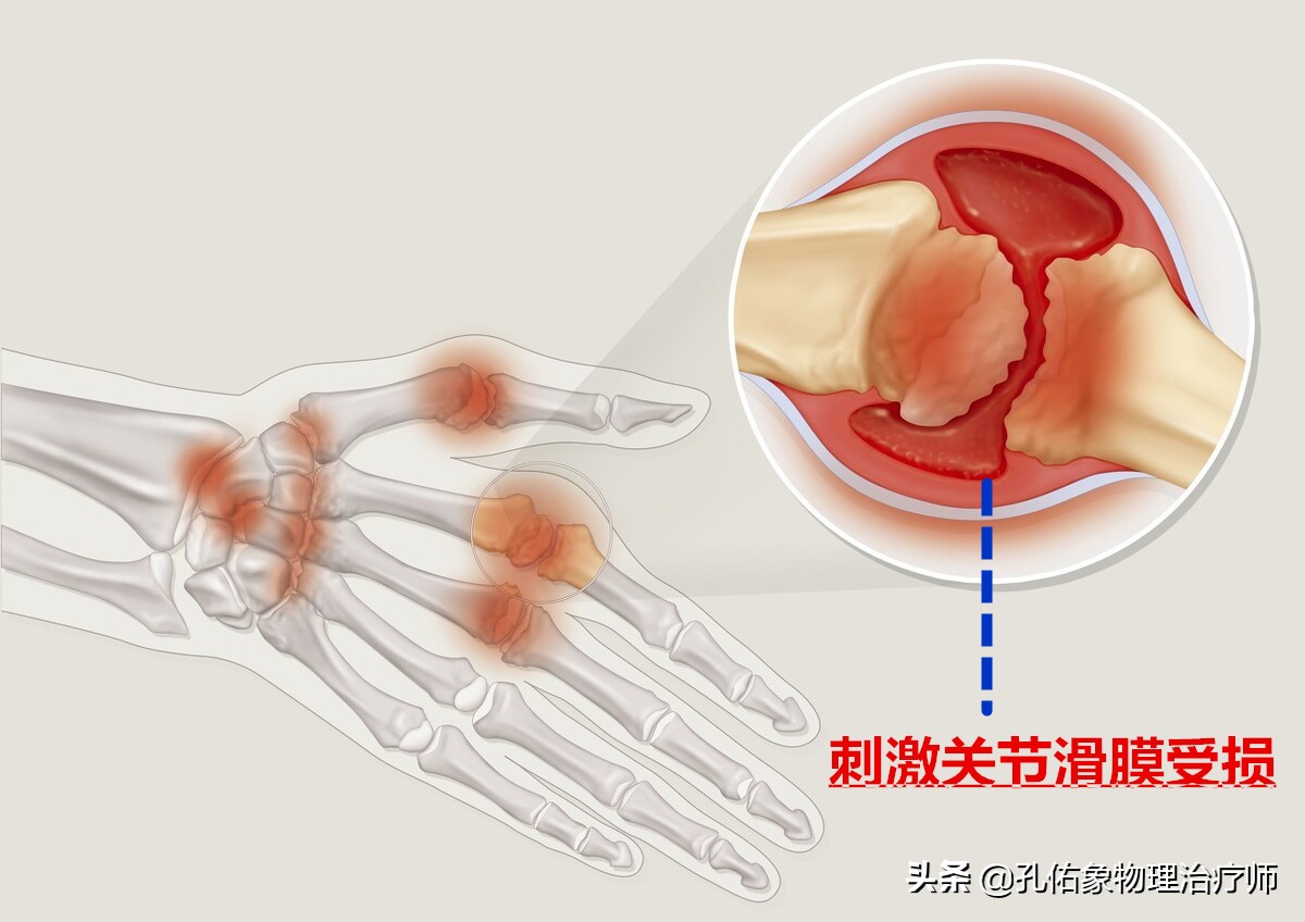 手指发胀捏不拢拳是什么原因,手指发胀不灵活咋回事